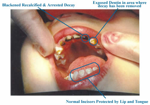 tooth remineralization