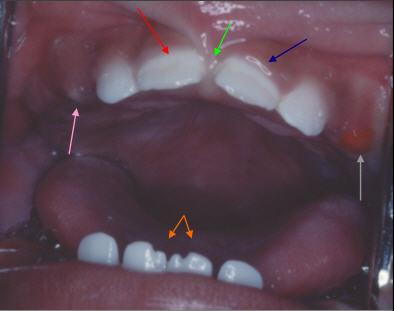 decalcification in baby teeth