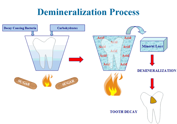 dental caries process