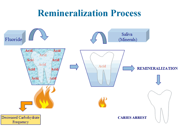 dental caries process